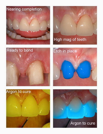 Insertion of Veneers Page4_resize_resize.jpg